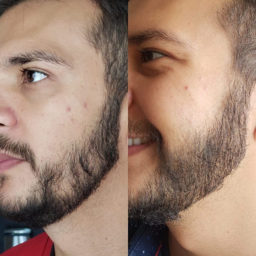 Como Fazer a Barba Crescer Mais Rápido